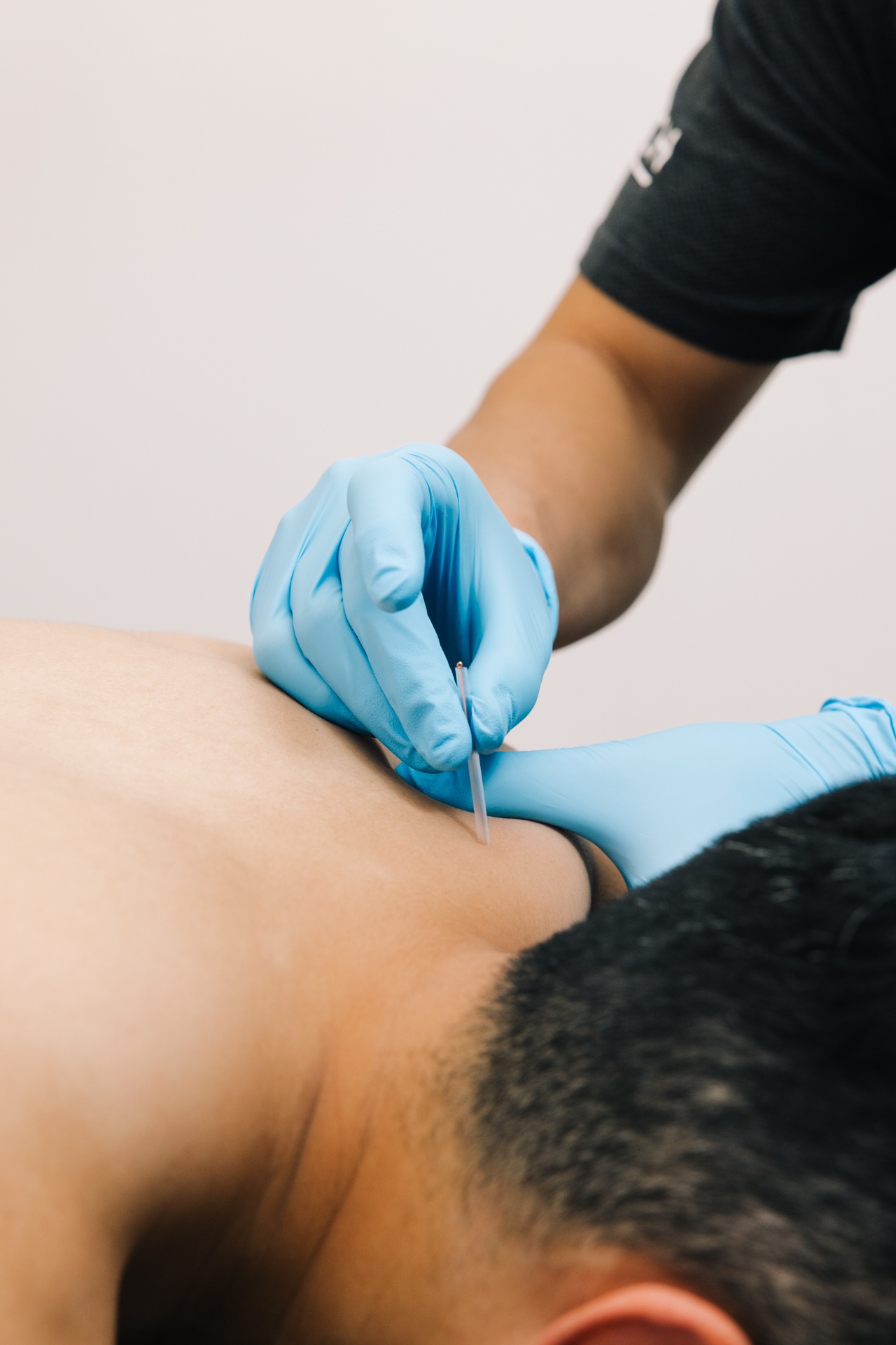 Acupuncture / IMS / Dry Needling